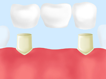連なった人工歯の橋をかけるブリッジ