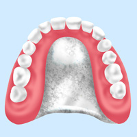 金属床義歯（自費診療）