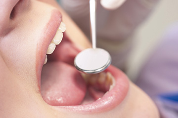 歯周病は定期的なクリーニングが大切です