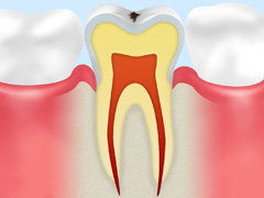 C0　ごく初期の虫歯