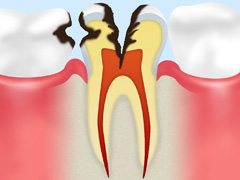 C2　象牙質の虫歯