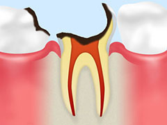 C3　神経の虫歯