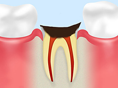 C4　歯根の虫歯