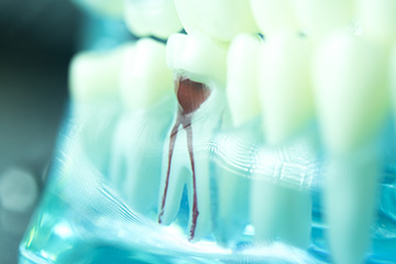 歯の根の治療で歯を残す～根管治療～